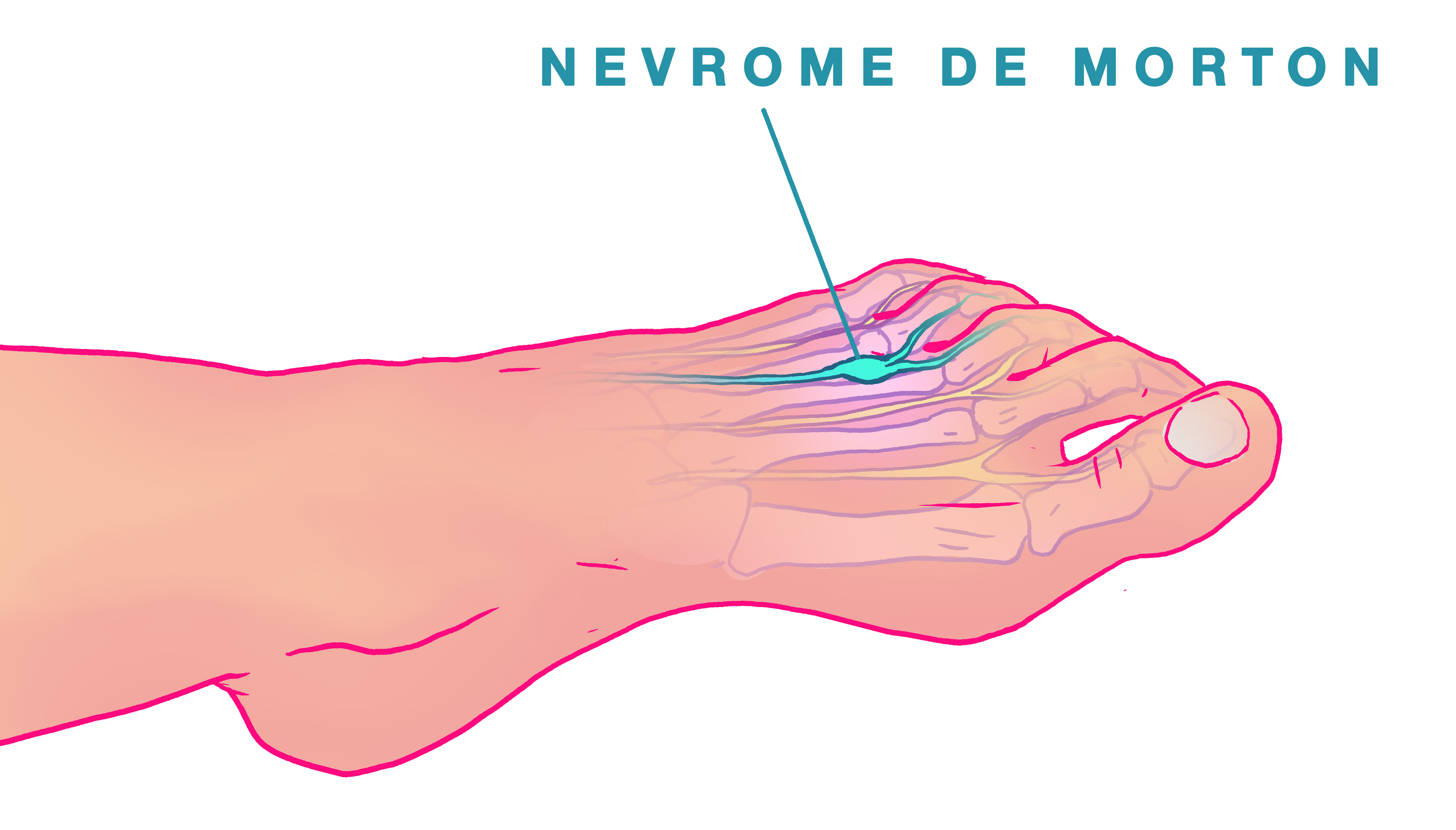 Un névrome de morton peut-il se résorber ?
